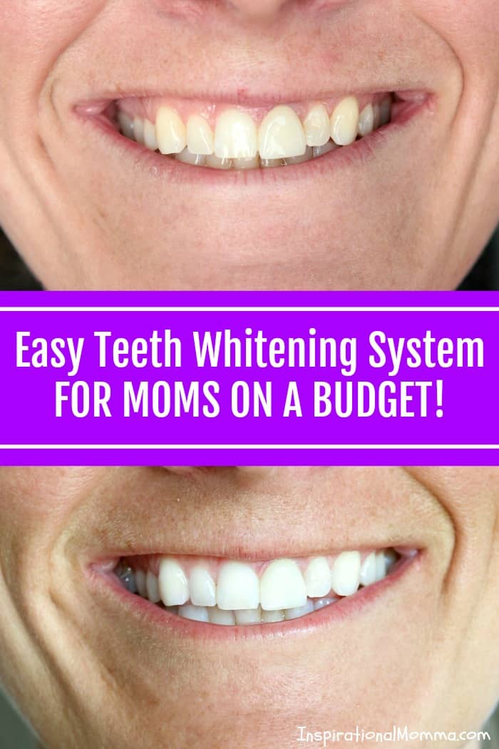 Smile Brilliant is a professional quality, at-home Easy Teeth Whitening System for Moms on a Budget that will deliver results you have been longing for!